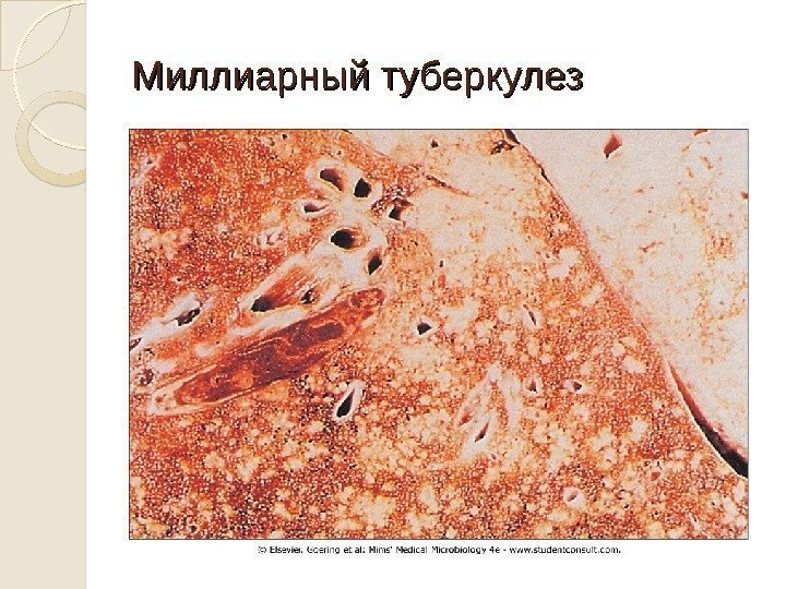 Миллиарный туберкулез 