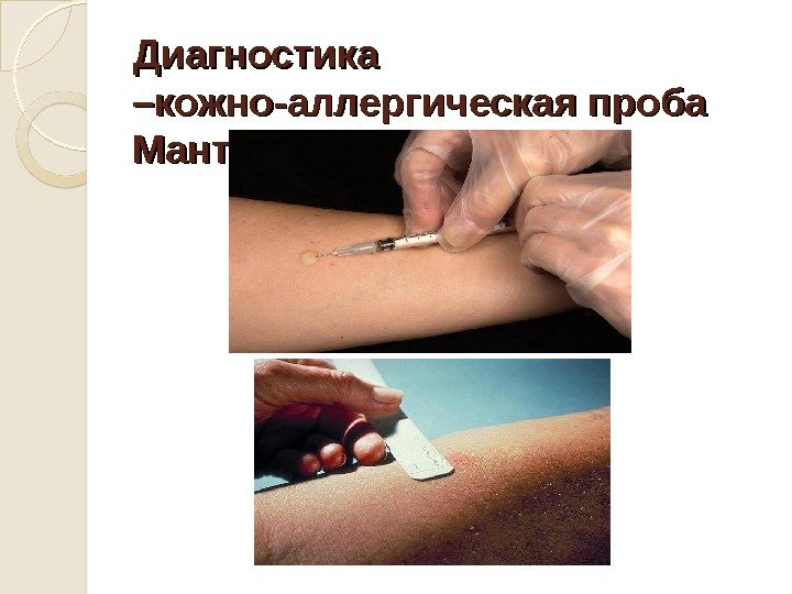 Диагностика –кожно-аллергическая проба Манту 