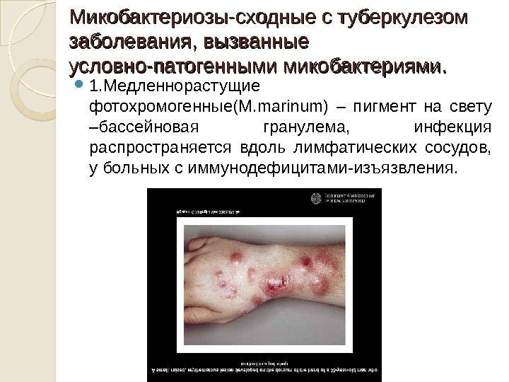 Микобактериозы-сходные с туберкулезом заболевания, вызванные условно-патогенными микобактериями.  1. Медленнорастущие фотохромогенные( M. marinum) –