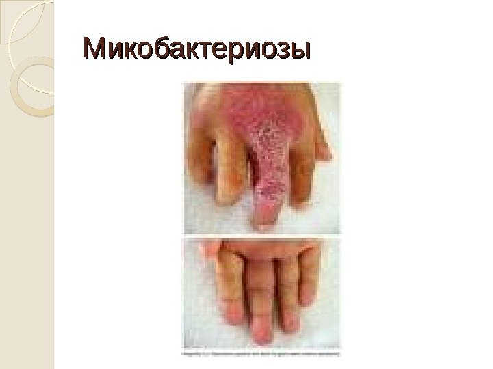 Микобактериозы 