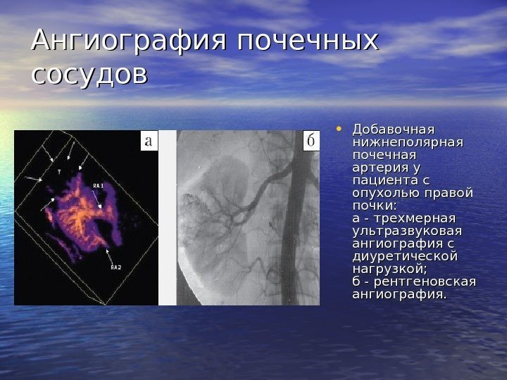 Ангиография почечных сосудов • Добавочная нижнеполярная почечная артерия у пациента с опухолью правой почки:
