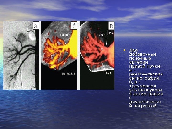  • Две добавочные почечные артерии правой почки: а - рентгеновская ангиография; б, в