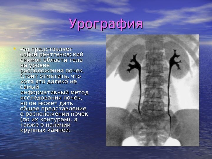 Урография • -он представляет собой рентгеновский снимок области тела на уровне расположения почек. 