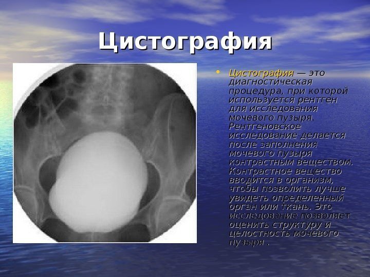 Цистография • Цистография — это диагностическая процедура, при которой используется рентген для исследования мочевого