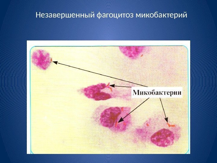Незавершенный фагоцитоз микобактерий 
