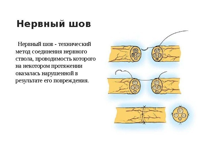 Нервный шов - технический метод соединения нервного ствола, проводимость которого на некотором протяжении оказалась