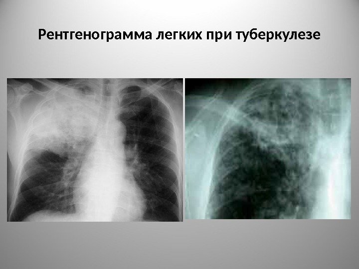 Рентгенограмма легких при туберкулезе 
