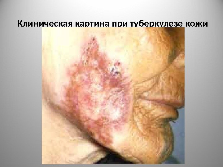 Клиническая картина при туберкулезе кожи 