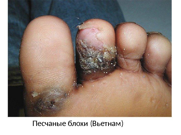 Песчаные блохи (Вьетнам) 