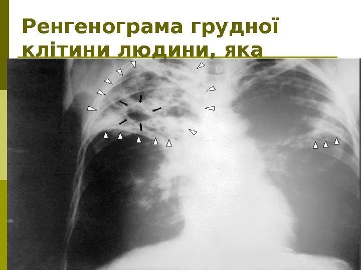 Ренгенограма грудної клітини людини, яка хворіє на туберкульоз  