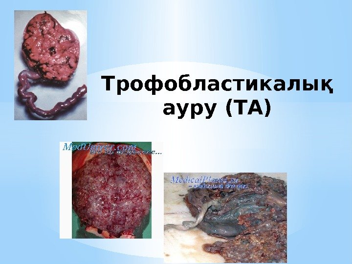 Трофобластикалық ауру (ТА) 