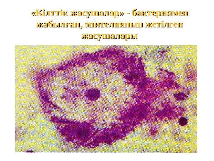  «Кілттік жасушалар» - бактериямен жабыл ан, эпителияны жетілген ғ ң жасушалары 