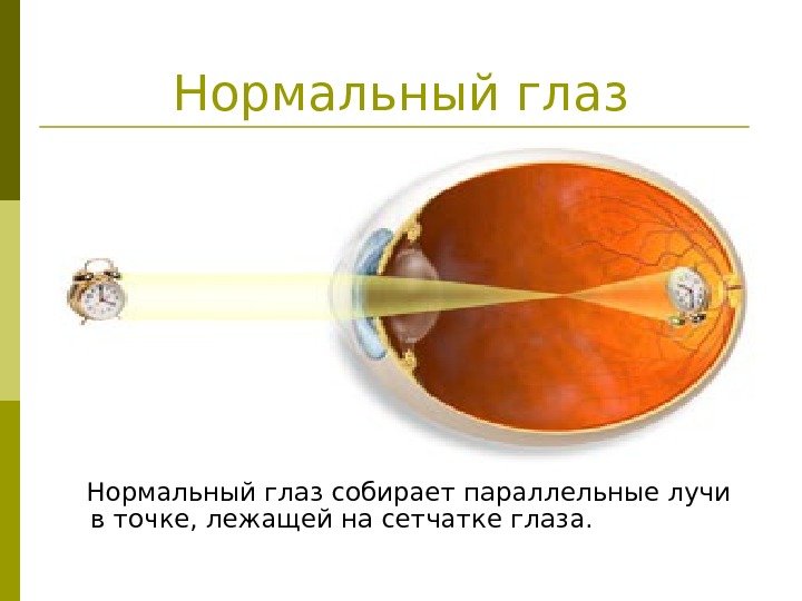   Нормальный глаз собирает параллельные лучи в точке, лежащей на сетчатке глаза. 