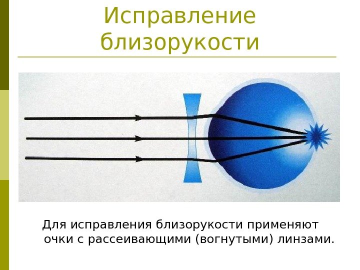   Исправление близорукости Для исправления близорукости применяют очки с рассеивающими (вогнутыми) линзами. 