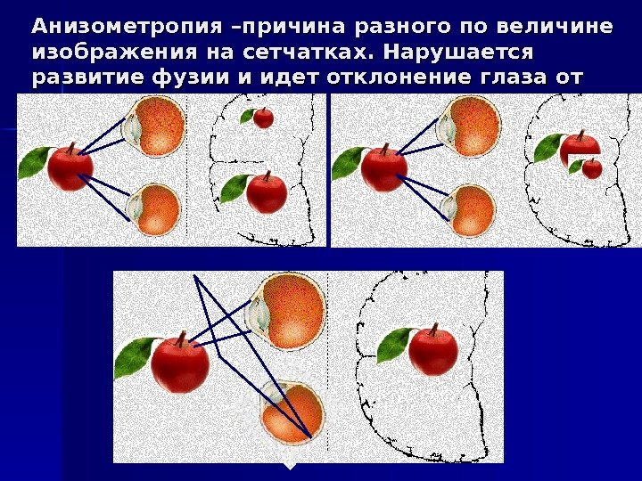   Анизометропия –причина разного по величине изображения на сетчатках. Нарушается развитие фузии и