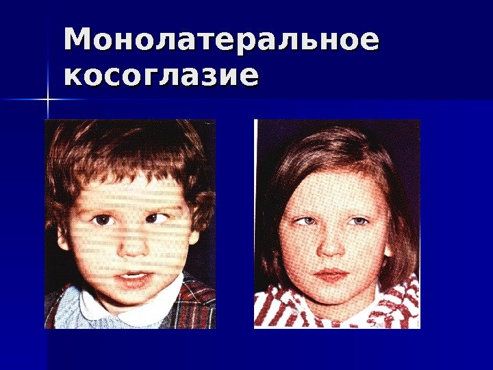   Монолатеральное косоглазие 