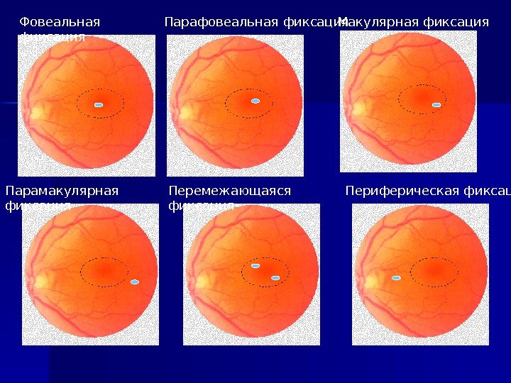   Фовеальная фиксация Периферическая фиксация. Перемежающаяся фиксация. Парамакулярная фиксация Макулярная фиксация. Парафовеальная фиксация