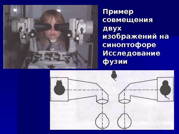   Пример совмещения двух изображений на синоптофоре Исследование фузии 