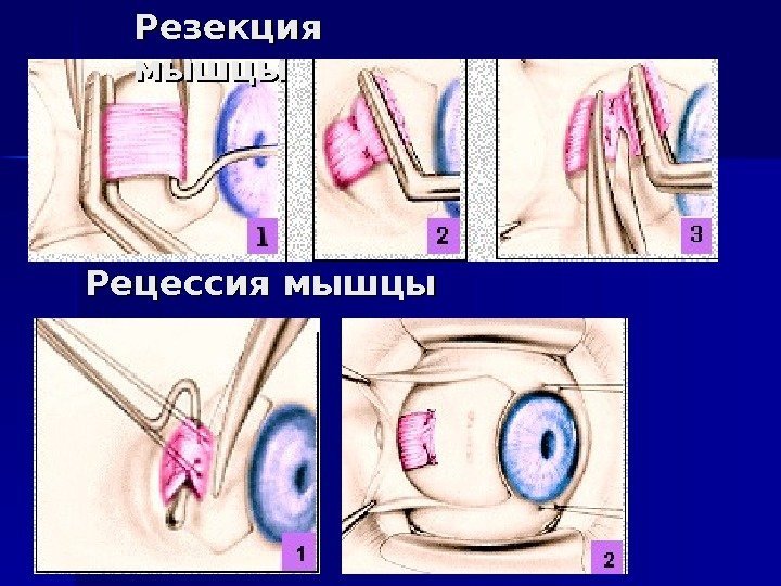   Резекция мышцы Рецессия мышцы 