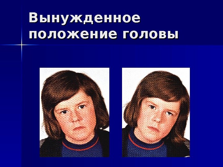   Вынужденное положение головы 