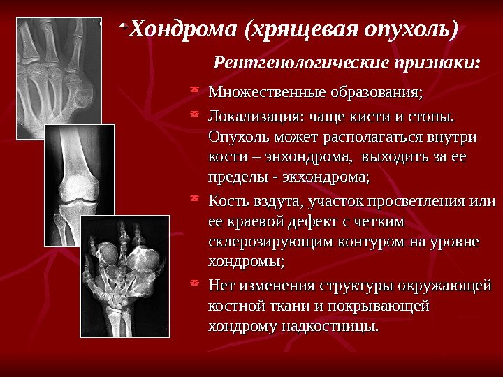 Хондрома (хрящевая опухоль) Рентгенологические признаки:  Множественные образования;  Локализация: чаще кисти и стопы.
