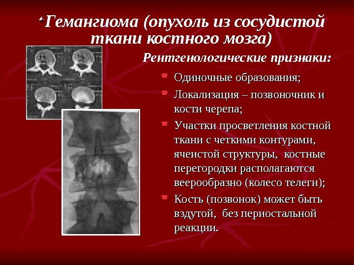 Гемангиома (опухоль из сосудистой ткани костного мозга) Рентгенологические признаки:  Одиночные образования;  Локализация