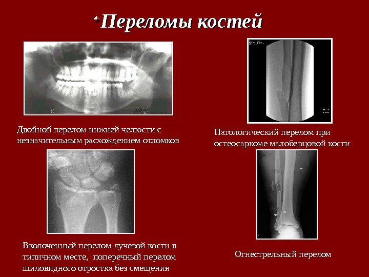 Переломы костей  Двойной перелом нижней челюсти с незначительным расхождением отломков Патологический перелом при