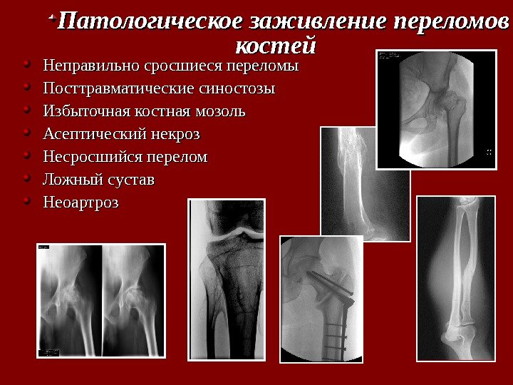 Неправильно сросшиеся переломы Посттравматические синостозы Избыточная костная мозоль Асептический некроз Несросшийся перелом Ложный сустав
