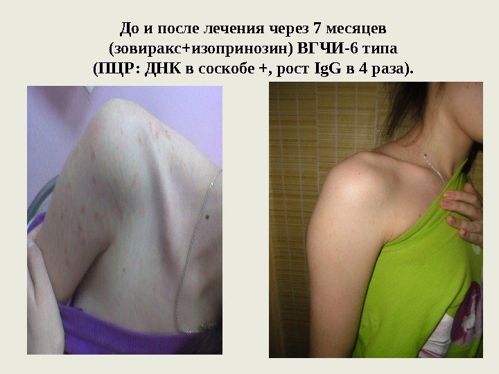 До и после лечения  через 7 месяцев (зовиракс+изопринозин)  ВГЧИ-6 типа (ПЦР: ДНК