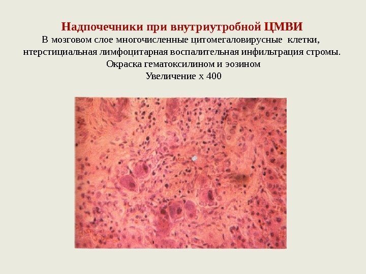 Надпочечники при внутриутробной ЦМВИ В мозговом слое многочисленные цитомегаловирусные клетки,  нтерстициальная лимфоцитарная воспалительная