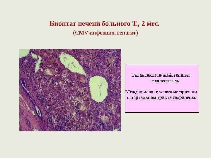 Биоптат печени больного Т. , 2 мес.  ( CMV- инфекция, гепатит) Гигантоклеточный гепатит