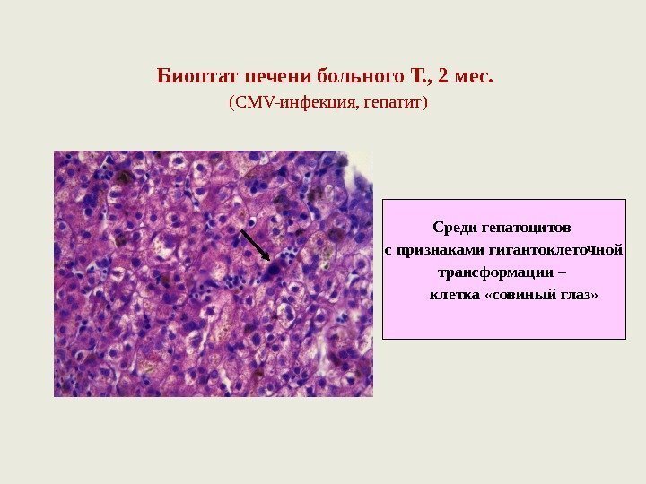 Биоптат печени больного Т. , 2 мес.  ( CMV- инфекция, гепатит) Среди гепатоцитов