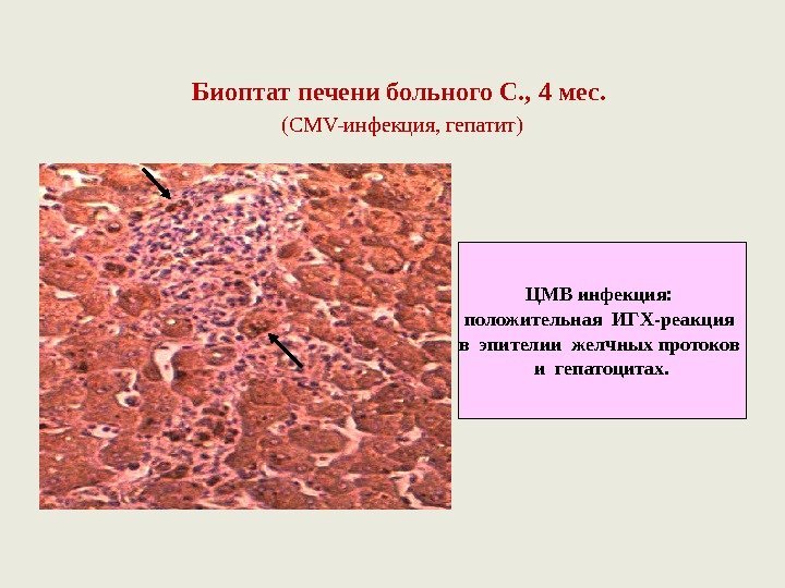 Биоптат печени больного С. ,  4 мес.  ( CMV- инфекция, гепатит) ЦМВ