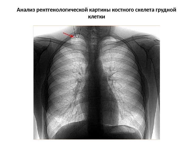 Анализ рентгенологической картины костного скелета грудной клетки 