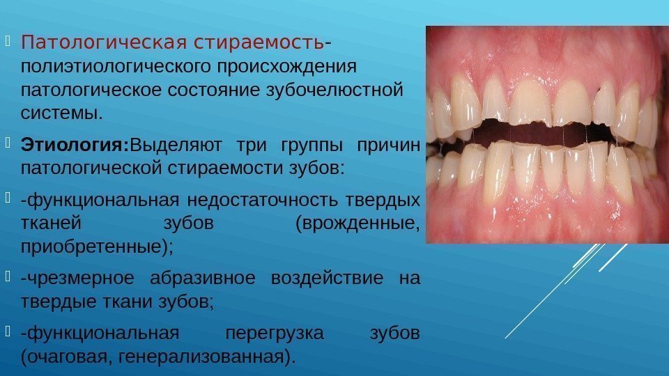 Патологическая стираемость зубов презентация