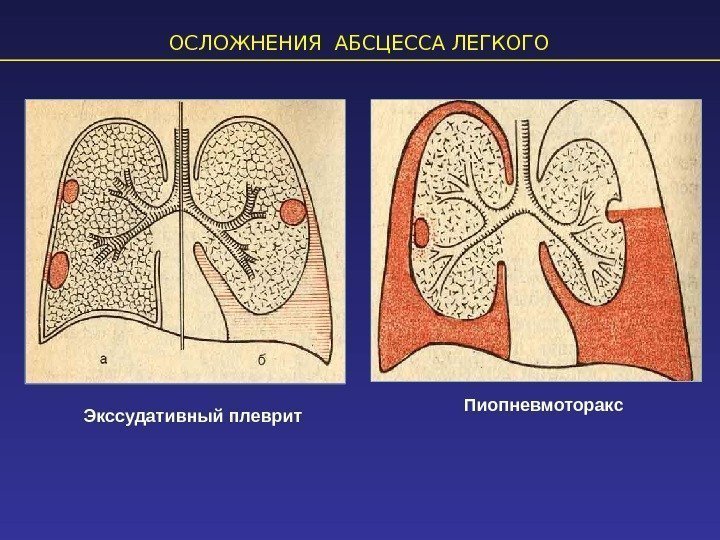 ОСЛОЖНЕНИЯ АБСЦЕССА ЛЕГКОГО Экссудативный плеврит Пиопневмоторакс 