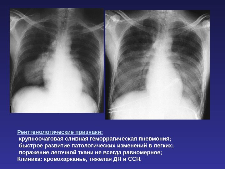 Рентгенологические признаки:  крупноочаговая сливная геморрагическая пневмония;  быстрое развитие патологических изменений в легких;