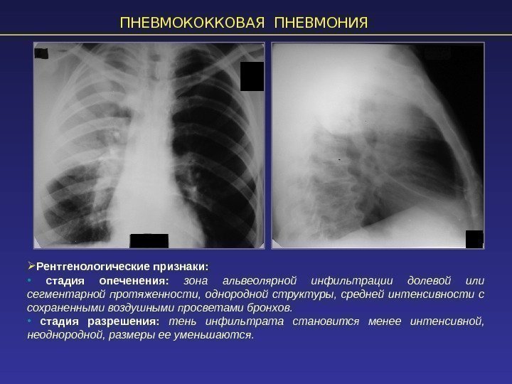 ПНЕВМОКОККОВАЯ ПНЕВМОНИЯ Рентгенологические признаки:  •  стадия опеченения:  зона альвеолярной инфильтрации долевой