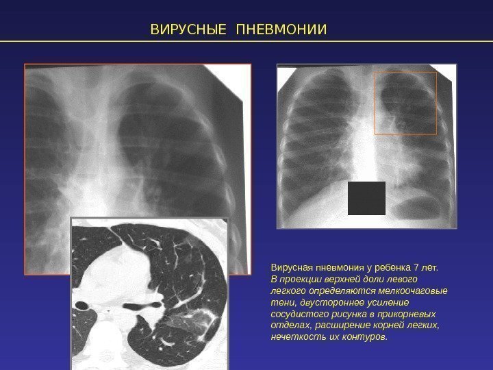 ВИРУСНЫЕ ПНЕВМОНИИ Вирусная пневмония у ребенка 7 лет. В проекции верхней доли левого легкого