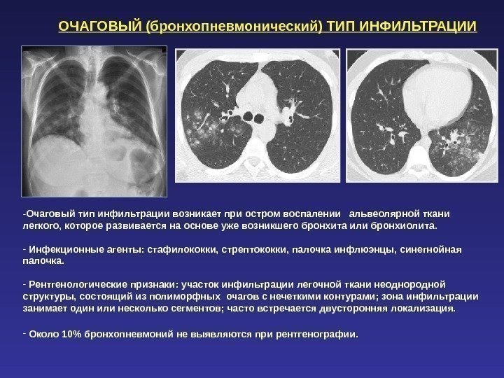 ОЧАГОВЫЙ (бронхопневмонический) ТИП ИНФИЛЬТРАЦИИ - Очаговый тип инфильтрации возникает при остром воспалении  альвеолярной