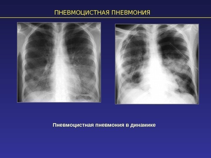 ПНЕВМОЦИСТНАЯ ПНЕВМОНИЯ Пневмоцистная пневмония в динамике 