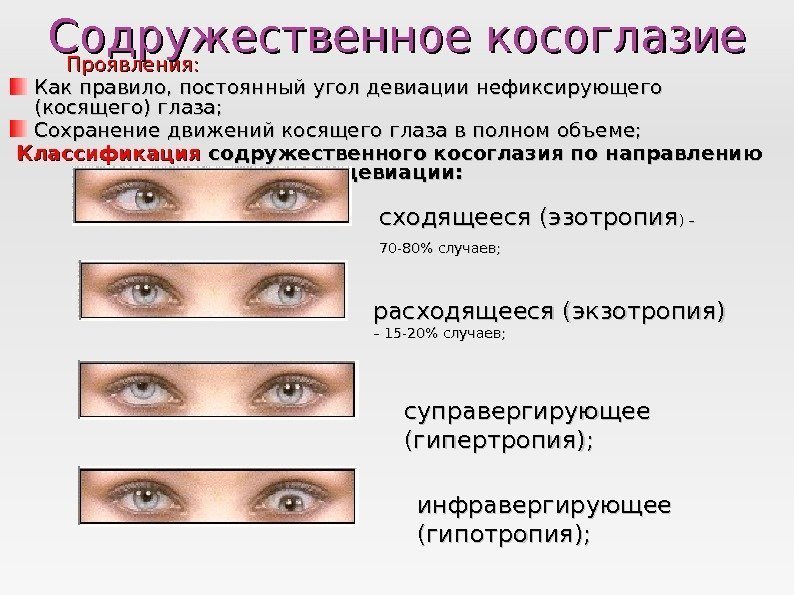   Проявления: Как правило, постоянный угол девиации нефиксирующего (косящего) глаза; Сохранение движений косящего