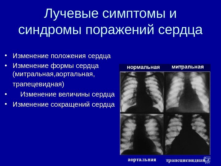 Лучевые симптомы и синдромы поражений сердца • Изменение положения сердца • Изменение формы сердца