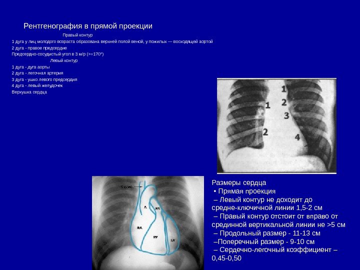   Рентгенография в прямой проекции       Правый контур