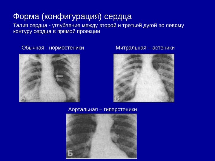 Форма (конфигурация) сердца Талия сердца - углубление между второй и третьей дугой по левому