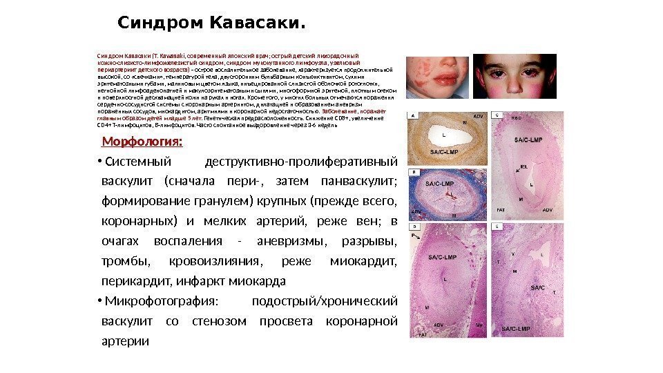 Синдром Кавасаки (Т. Kawasaki, современный японский врач; острый детский лихорадочный кожно-слизисто-лимфожелезистый синдром, синдром мукокутанного