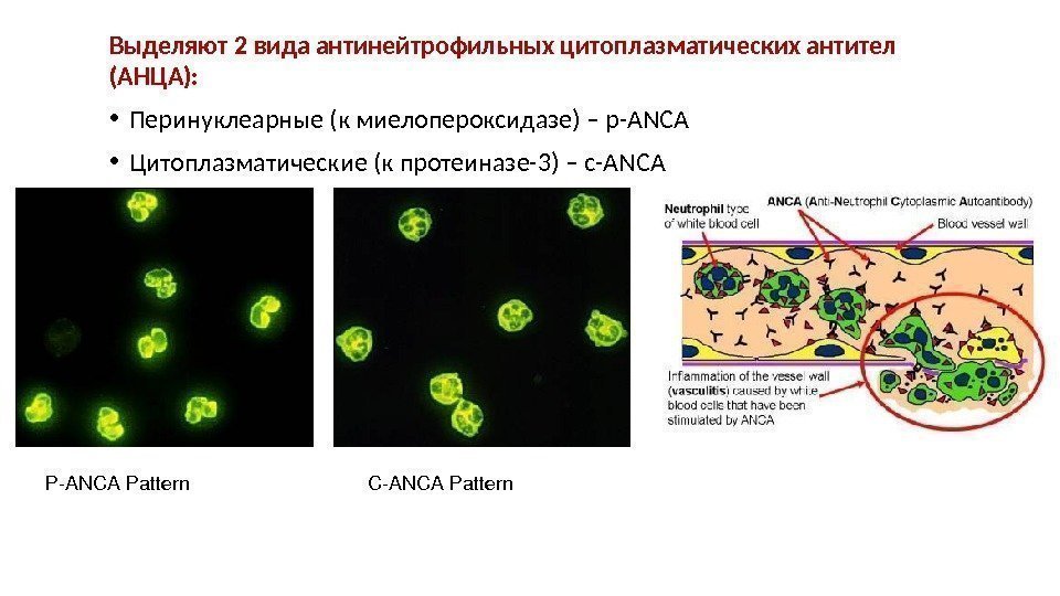 Выделяют 2 вида антинейтрофильных цитоплазматических антител (АНЦА):  • Перинуклеарные (к миелопероксидазе) – p-ANCA