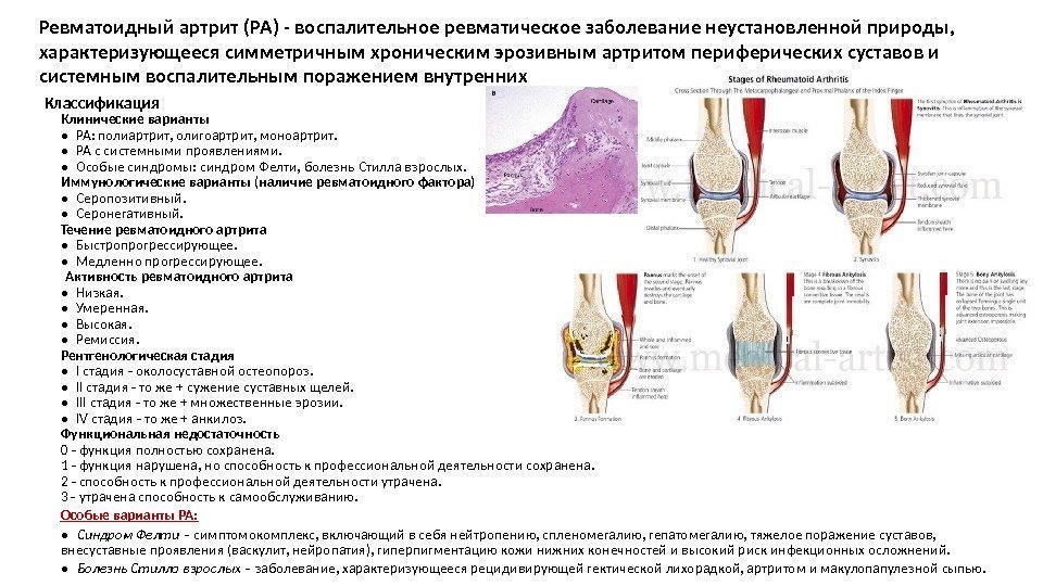 Ревматоидный артрит (РА) - воспалительное ревматическое заболевание неустановленной природы,  характеризующееся симметричным хроническим эрозивным