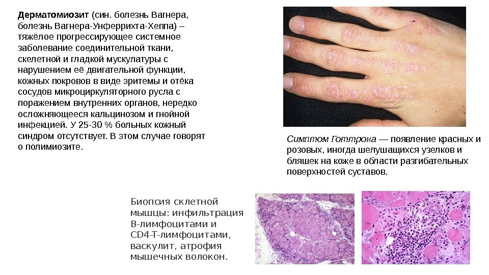 Дерматомиозит (син. болезнь Вагнера,  болезнь Вагнера-Унферрихта-Хеппа) –  тяжёлое прогрессирующее системное заболевание соединительной