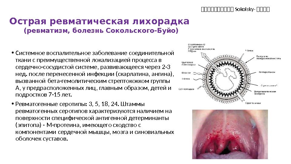 Острая ревматическая лихорадка (ревматизм, болезнь Сокольского-Буйо) • Системное воспалительное заболевание соединительной ткани с преимущественной